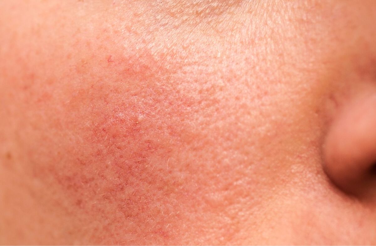 Sun damaged skin on face